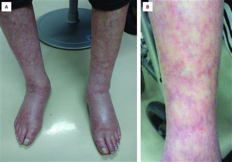 A Bilateral Pitting Edema Of The Lower Legs With Concurrent Livedo