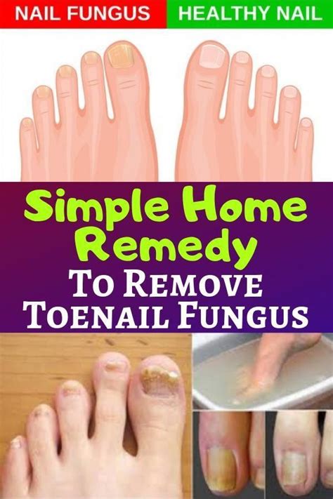 Simple Home Remedy To Remove Toenail Fungus Toenail Fungus Skin Care