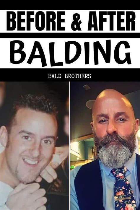 Balding Before And After Bald Is Beautiful Balding Baldness Cure
