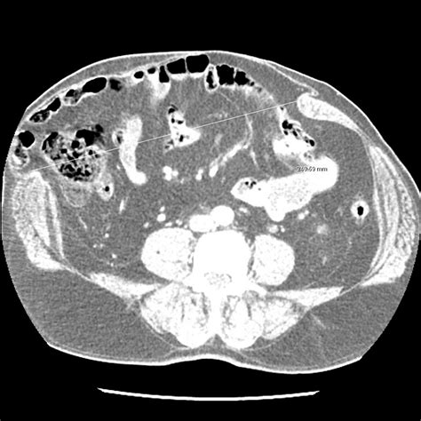 Cureus Giant Incisional Hernia Repair Using Open Intraperitoneal Dual