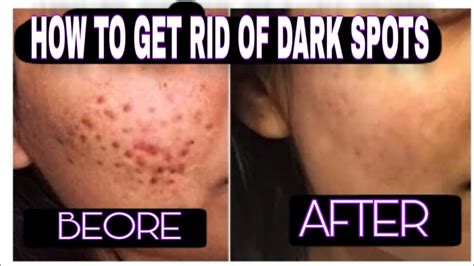 How To Get Rid Of Dark Spots And Hyper Pigmentation Fast Youtube
