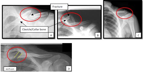 Clavicle Collar Bone Fractures Boston Shoulder Institute