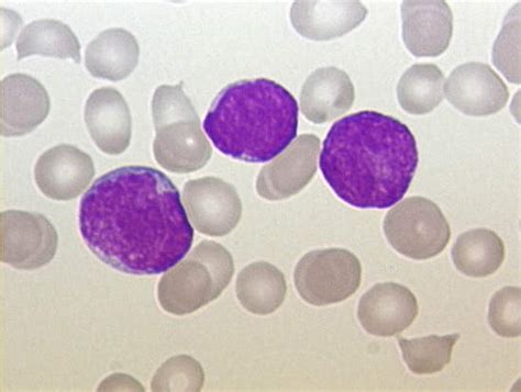 Acute B Lymphoblastic Leukemia B All Flow Cytometry