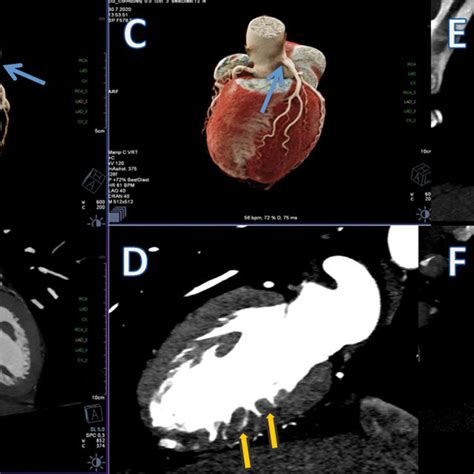 A Cardiac Ct 3d Volume Rendering Image Demonstrates The High Take Off