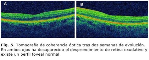 desprendimiento de retina exudativo como primera manifestación de una preeclampsia grave ramos