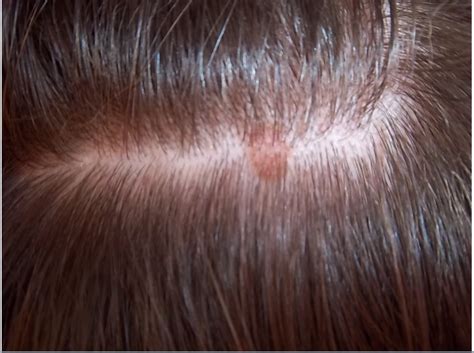 Red Spots On Scalp Pictures Photos