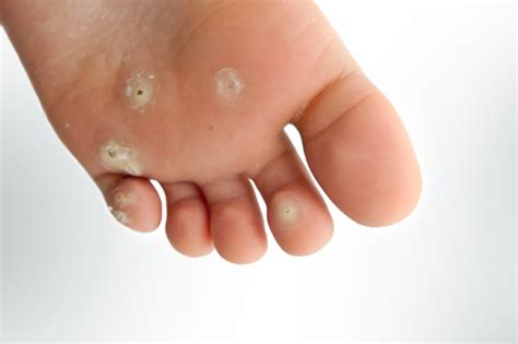 Like calluses, corns consist of excessive tough skin buildup at areas of excessive pressure on the feet. The Most Effective Ways to Rid Your Feet of Corns | Footfiles