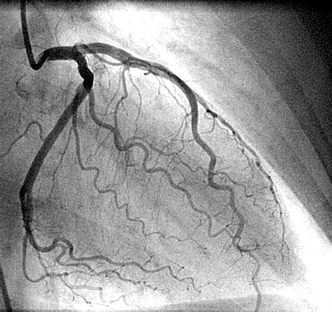 What Is The Simplest Possible Guideline For Doing Coronary Angiogram Following Acute Myocardial