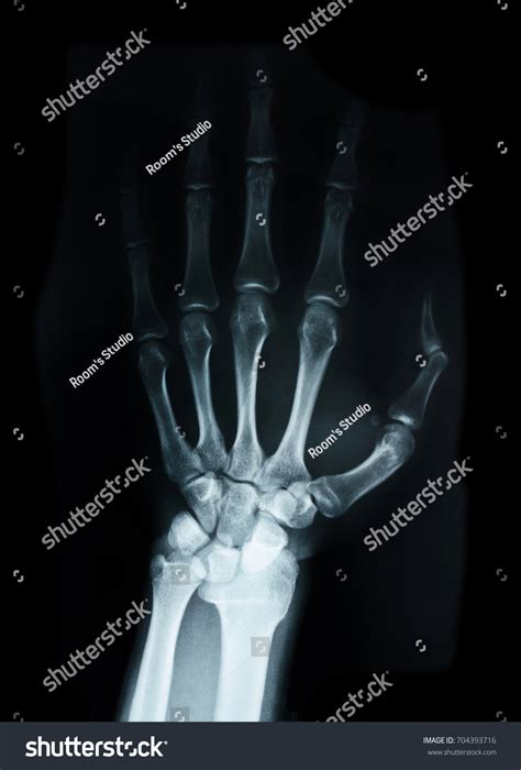 Carpal Bones Human X Ray On Stock Photo 704393716 Shutterstock