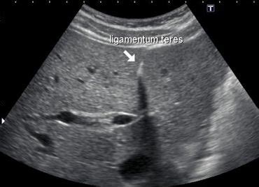 Ligamentum falciforme hepatis (falciform ligament): WK 2 LIVER Ligamentum Teres | Ultrasound, Diagnostic ...