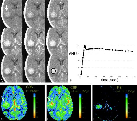 Dynamic Contrast Enhanced Ct Of Human Brain Tumors Quantitative