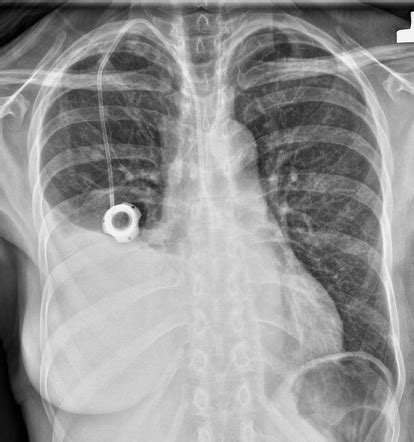 Central Venous Catheter Radiology Reference Article Radiopaedia Org