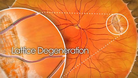 Lattice Degeneration Of Retina Causes Symptoms Diagnosis Prognosis