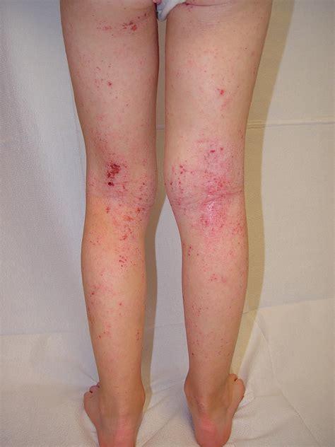 Eczema Symptoms Causes Treatments Types Triggers