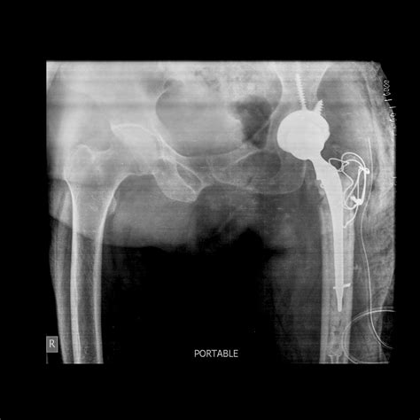 Uncemented Total Hip Replacement Dhs To Thr Conversion Thr Dr