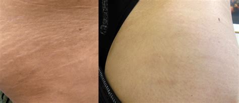 Laser Stretch Mark Removal Treatment London Premier Laser