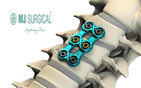 What Are Benefits And Alternatives Of Anterior Cervical Plate Surgery