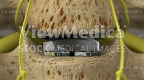 Viewmedica Stock Art Artificial Disc In Cervical Spine