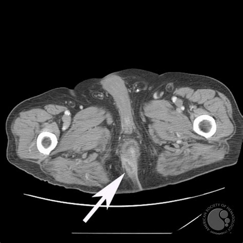 Perirectal Abscess 1