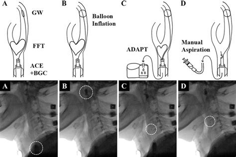 Endovascular Treatment Of Asymptomatic Free Floating Thrombus In The Carotid Artery Bifurcation