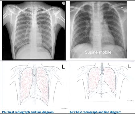 Chest Posterior Anterior Pa Radiograph A Chest Pa Rad