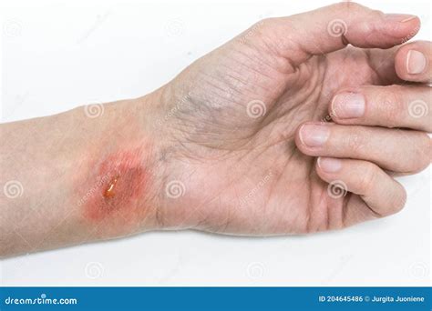 Burn Of A Skin On Womanâ€™s Hand Isolated On White Burst Blister On