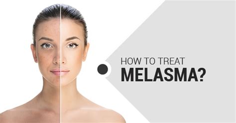 What Is Melasma And How Is It Treated Fairview Laser Clinic Inc