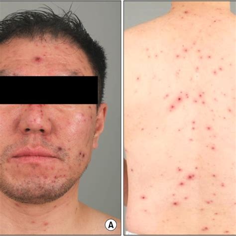 Erythematous Papules Vesicles And Scabs Were Diffusely Scattered On