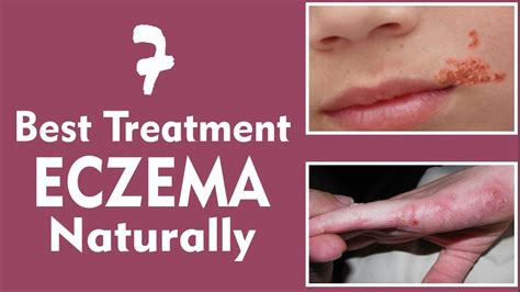7 Ways To Cure Eczema With Natural Ingredients Youtube