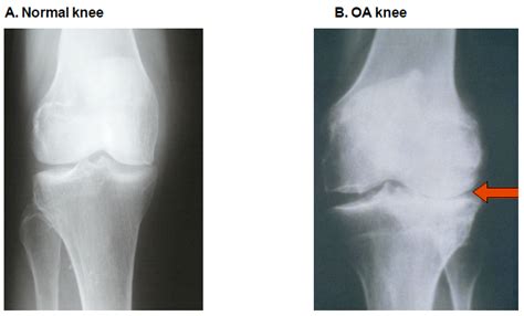 Radiological Differences Between Normal And Oa Joints A Normal Knee