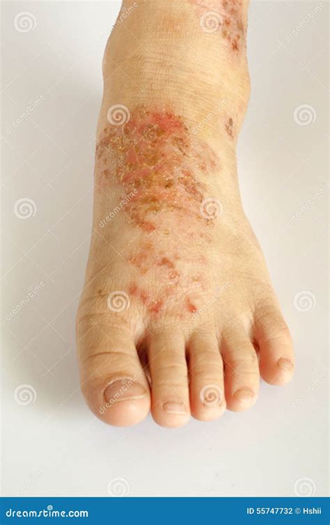 Eczema Stock Photo Image Of Closeup Health Patient 55747732