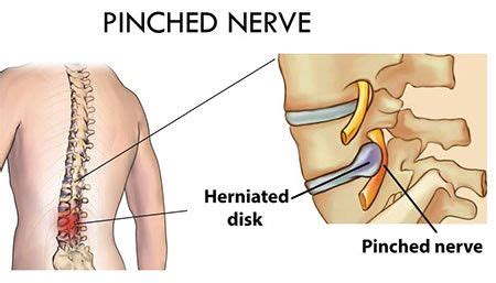 Pinched Nerve Treatment In Nj Pain Management Doctor Specialist