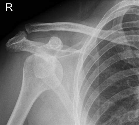 Shoulder Dislocation X Ray Images And Treatments New Health Advisor