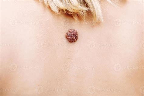 Wart Mole Big Wart On The Skin Skin Diseases Malignant Tumor