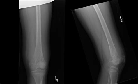 Ap And Lateral Radiographs Of The Left Femur