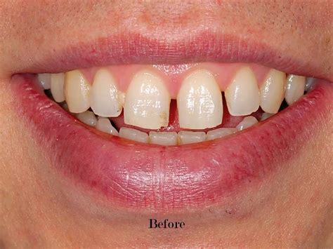 Are you conscious of the gaps between your teeth? Before/After - Tooth Gaps - YouTube
