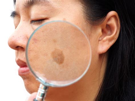 Oral Tranexamic Acid May Be A Treatment For Melasma In Patients With
