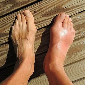 BREAKING! Gout And Arthritis: Report Warns That Global Incidences Of Gout Increasing ... Gout  
