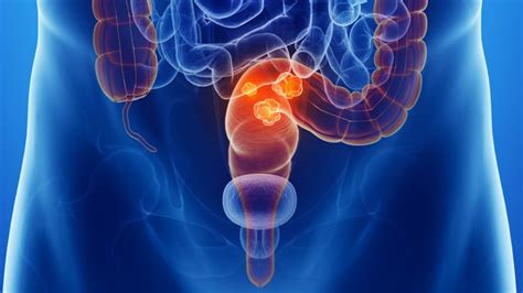 Rectal Cancer Survival Significantly Improved In Recent Years