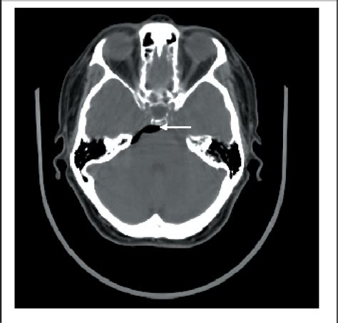 Axial Ct Scan Windowed For Bone Revealing Pneumocephaly In The