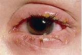 Can Sinus Problems Cause Watery Eyes Pictures