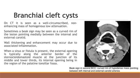 Cystic Neck Masses