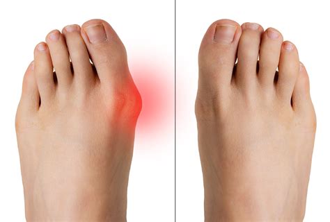 How To Choose The Best Bunion Shoe For Bunion Relief Feetcare