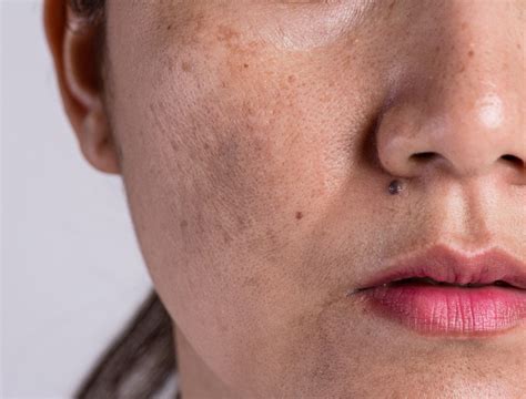 Pigmentation Symptoms Causes Skin Institute
