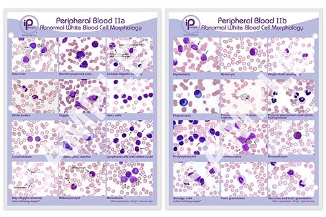 Peripheral Blood Ii Abnormal White Blood Cell Morphology