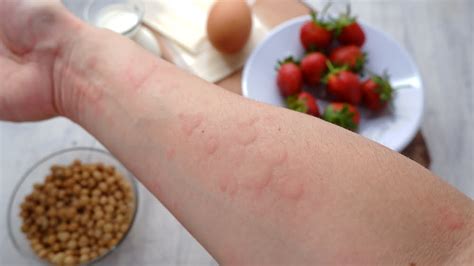 5 Food Allergy Triggers Of Hives And Skin Rashes Food Allergies Atlanta