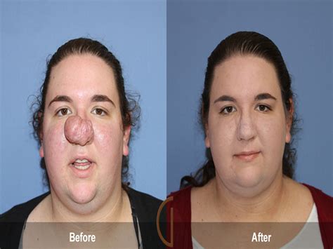 Plastic Surgery Before And After Nose Reconstructive Surgery Of The Nose
