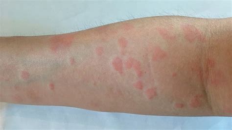 Causes Of A Red Circle On The Skin Other Than Ringworm