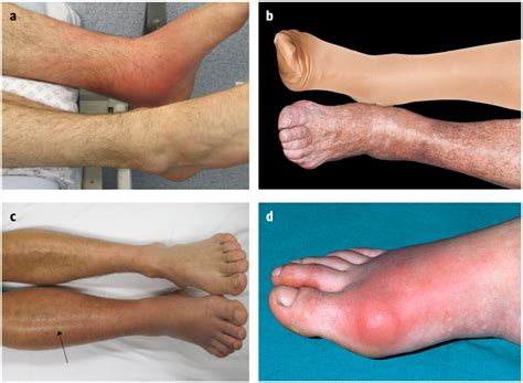 If the cellulite is mild, then the improvement is generally about 90 percent, if the cellulite is moderate then the improvement will be about 70 percent, if it's severe cellulite he said he thinks it is important to show patients pictures of those different degrees of severity and the outcome that they can expect. What diagnostic strategies can help differentiate ...
