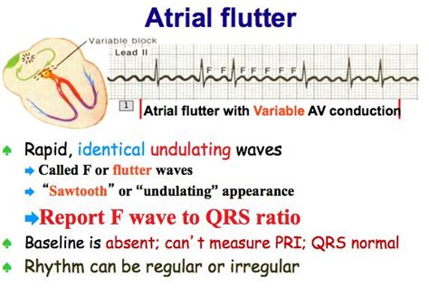 Whats The Difference Between Atrial Flutter And Atrial Fibrillation Images And Photos Finder
